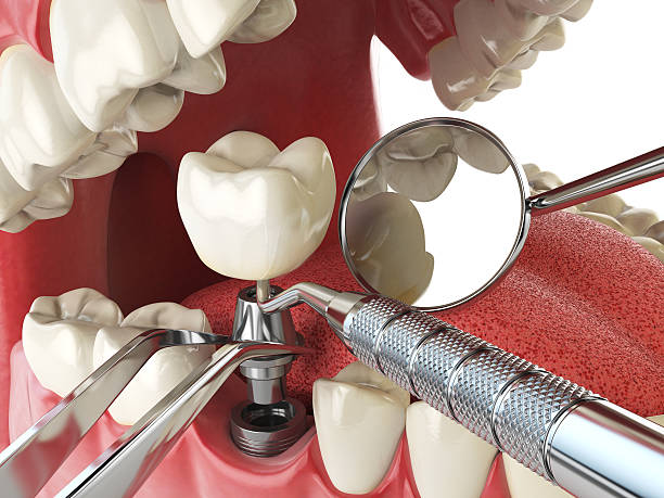 Best Dental Abscess Treatment in South Amherst, OH